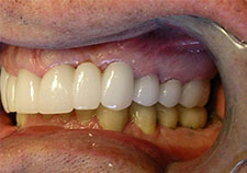 pinnacle peak dentistry scottsdale az smile gallery after
