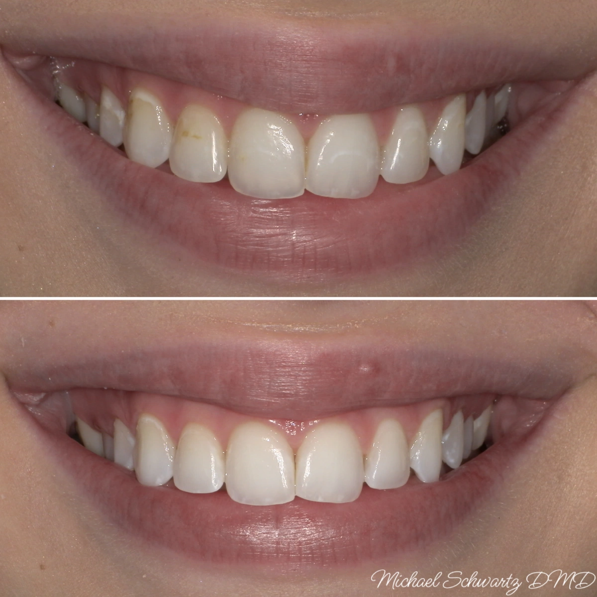 Show a smile close-up (left) and an intraoral view (right) displaying teeth with slight yellowing and minor surface discoloration.