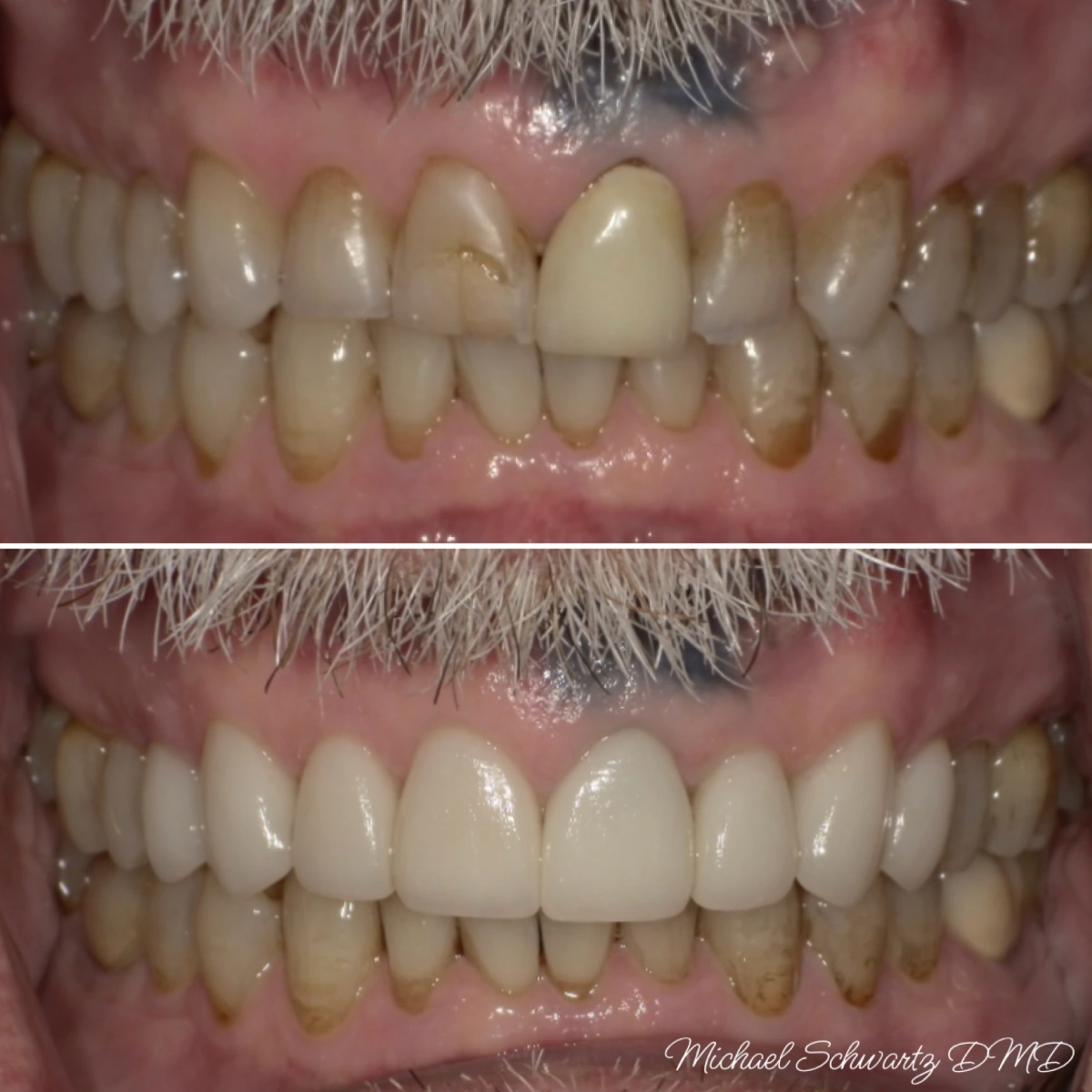 Shows a close-up intraoral view transforming worn, discolored upper teeth into a straight, bright white smile.
