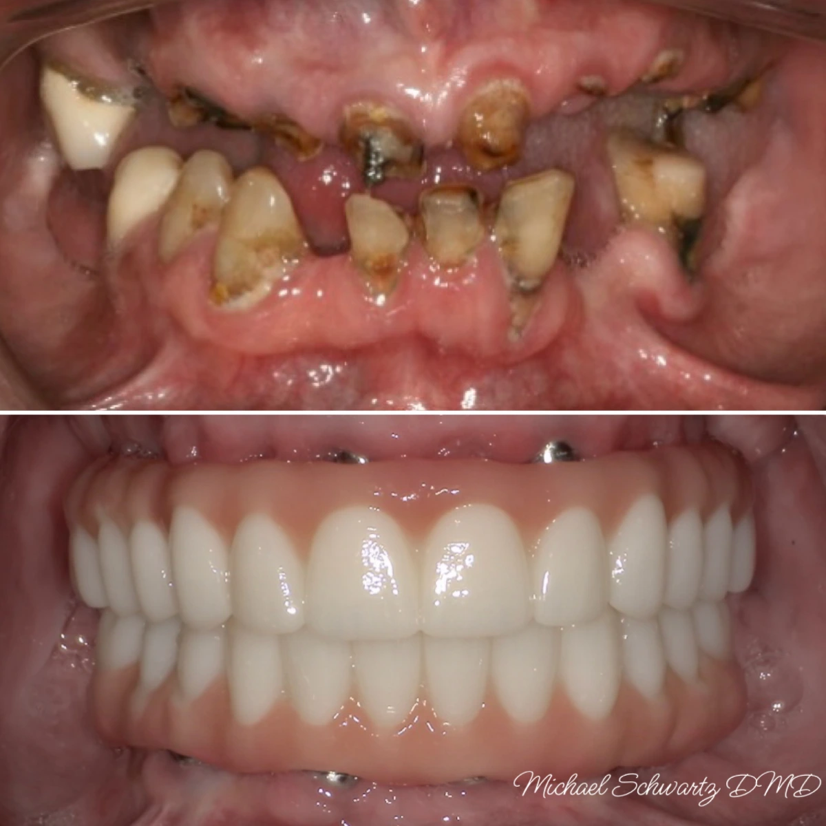 Shows an extreme close-up intraoral view transforming severely broken, decayed, and missing teeth into a full set of top and bottom dental implants.