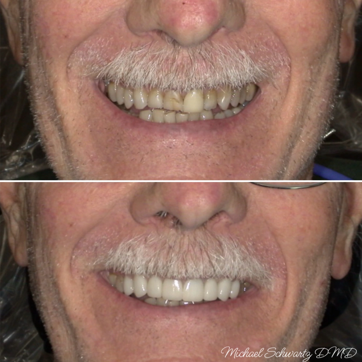 Shows a man with a mustache smiling, transitioning from crowded, misaligned teeth to a uniform, bright smile.