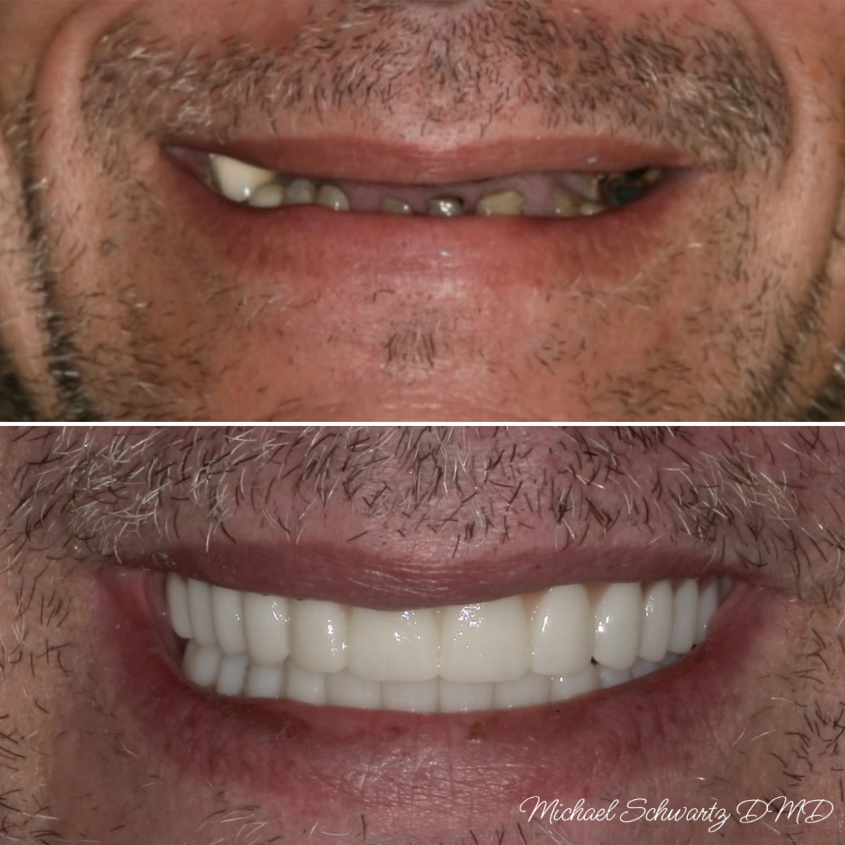 Shows a close-up smile view of a man with stubble, transitioning from mostly missing or receded teeth to a full set of bright white dentures.