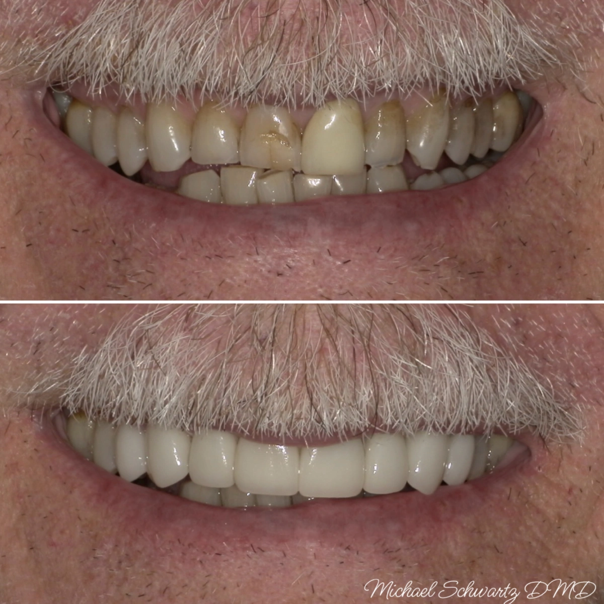 Shows a close-up smile view of a man with a mustache, transforming heavily stained and uneven teeth into a clean, white smile.