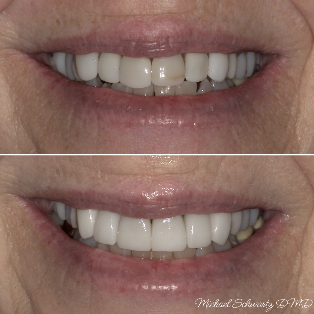 Shows a close-up smile view of a patient transforming naturally uneven, dull teeth into symmetrical, porcelain-white teeth.