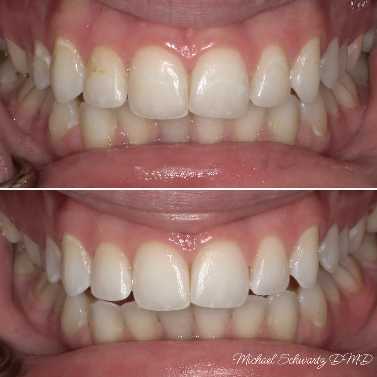 Show the corresponding smile close-up (left) and intraoral view (right) after treatment, displaying noticeably brighter, whiter, and more uniform teeth.