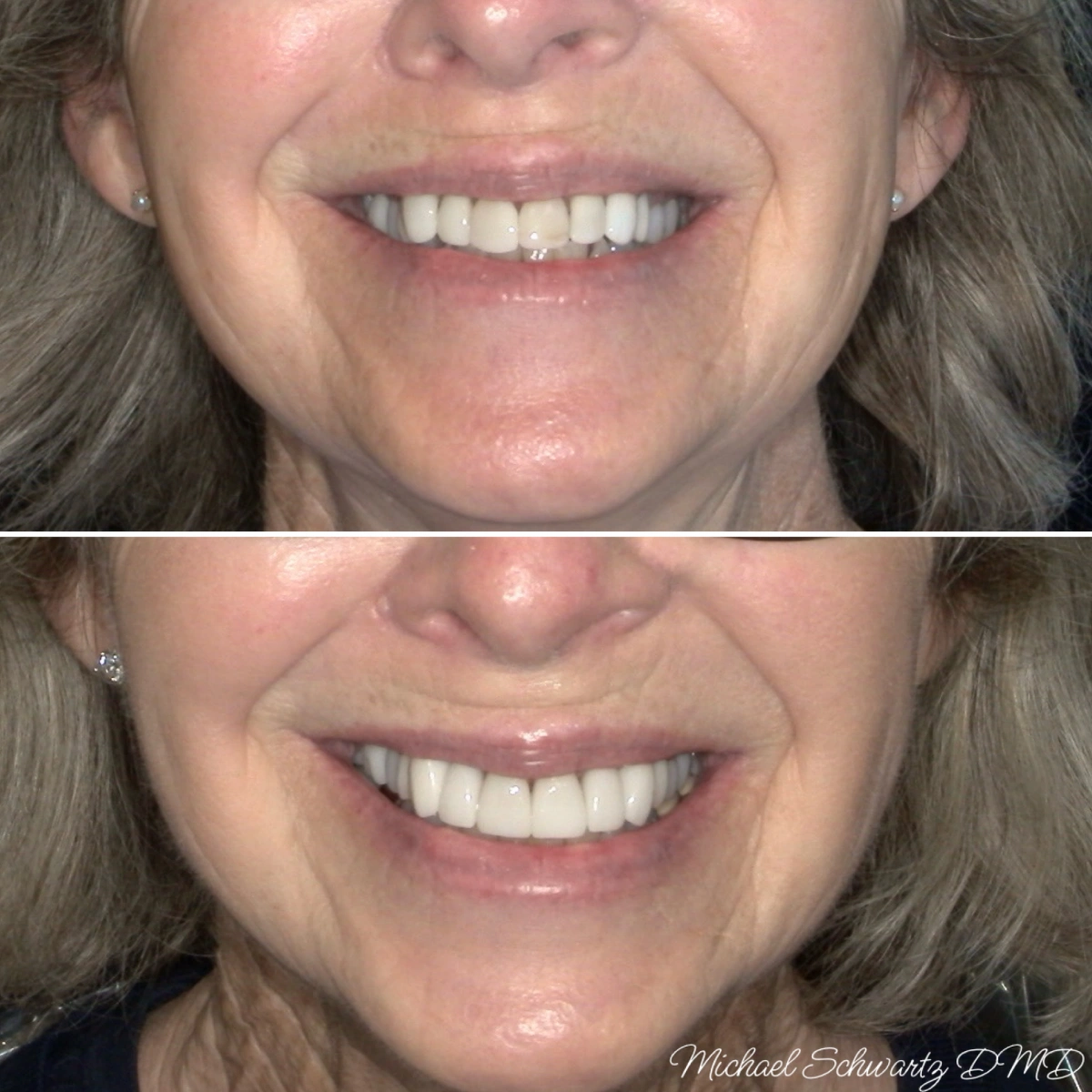 Shows a woman smiling, transitioning from slightly asymmetrical and discolored teeth to a bright, perfectly aligned smile.