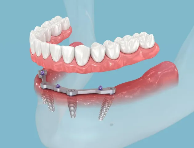All-on-4 dental implants in Scottsdale restoring full arch of missing teeth