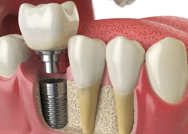 Dental Implants Scottsdale, AZ