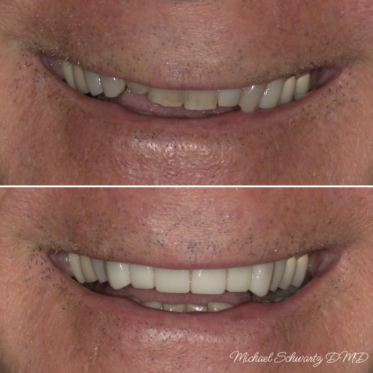 A before-and-after smile comparison image showing a cosmetic dental transformation of a patient's upper teeth, watermarked by Michael Schwartz, DMD.