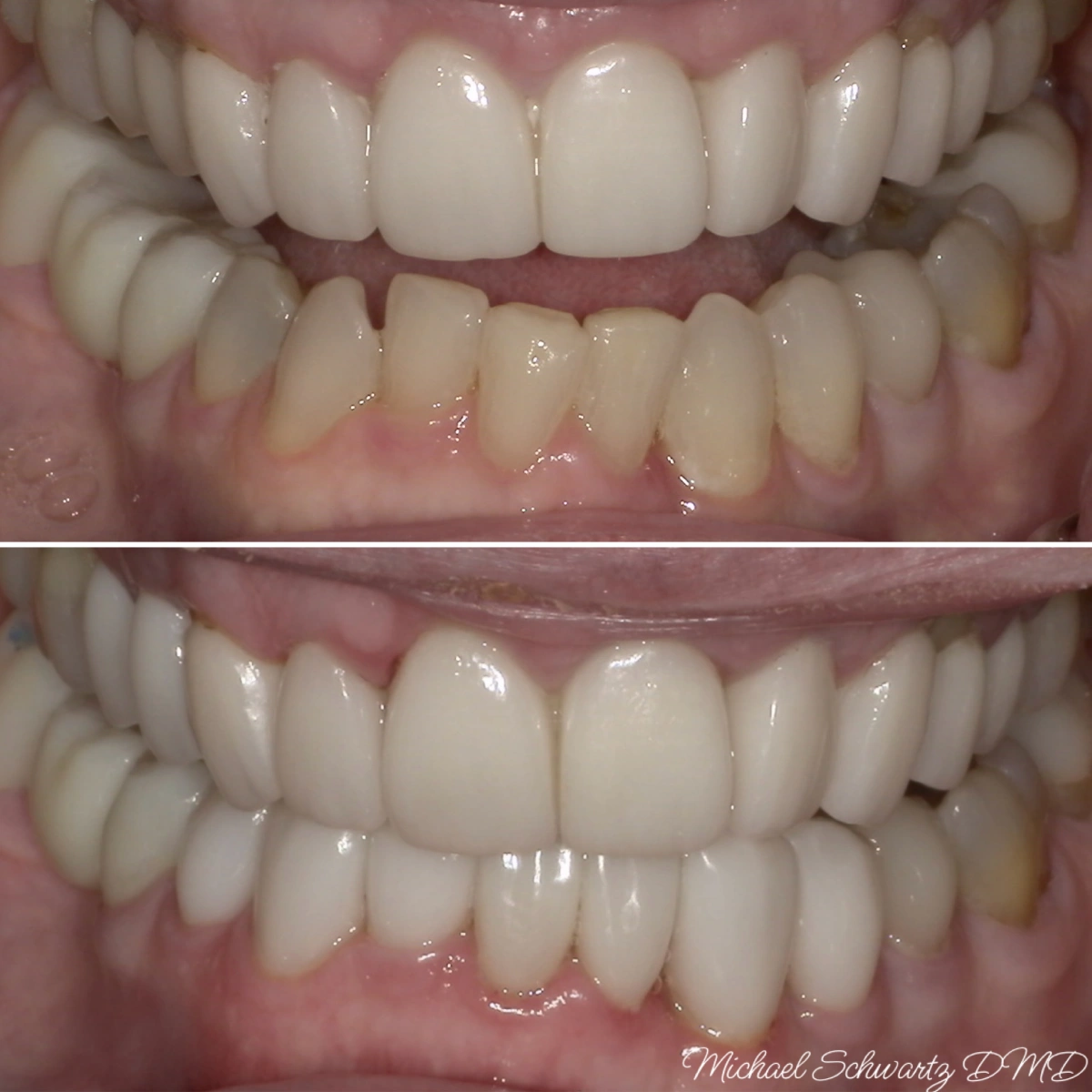 A before-and-after close-up dental comparison image showcasing cosmetic alignment and color restoration of the lower teeth, watermarked by Michael Schwartz, DMD.