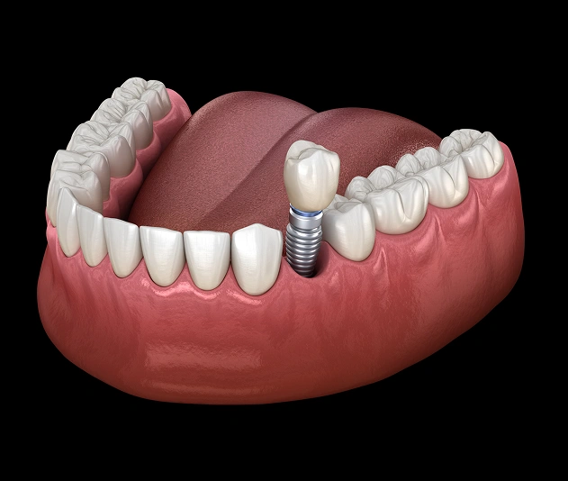 Single Dental Implants Scottsdale, AZ